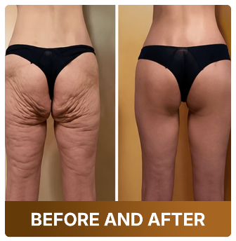 ✅Loose Skin — Powerful Firming