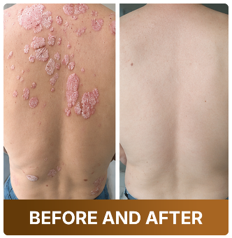 ♻️Psoriasis — Intensive Repair